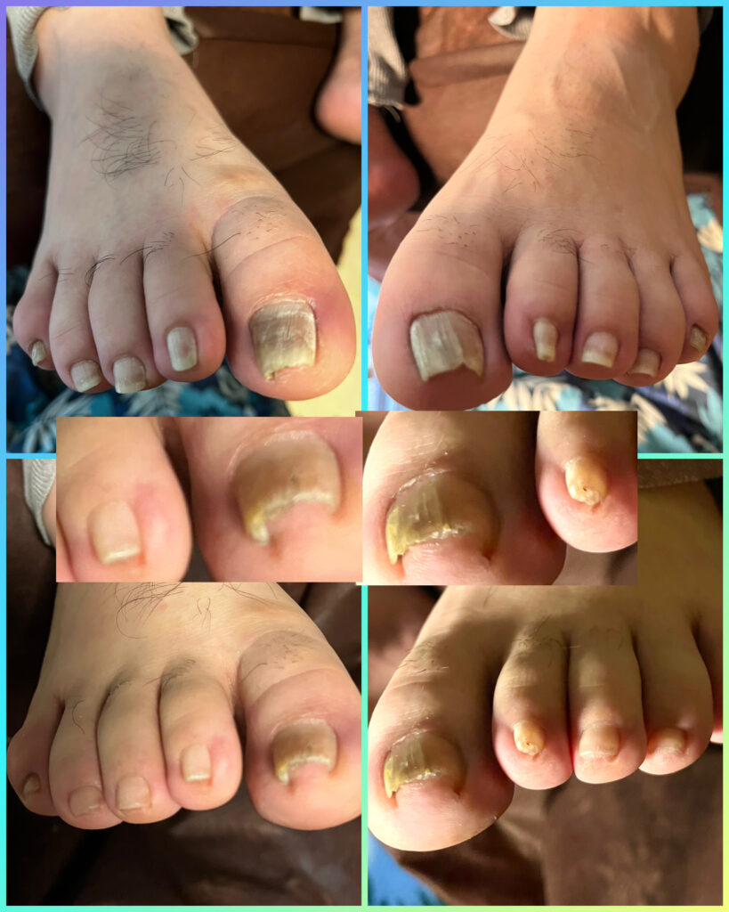 介護予防爪切り🦶✂️🦶