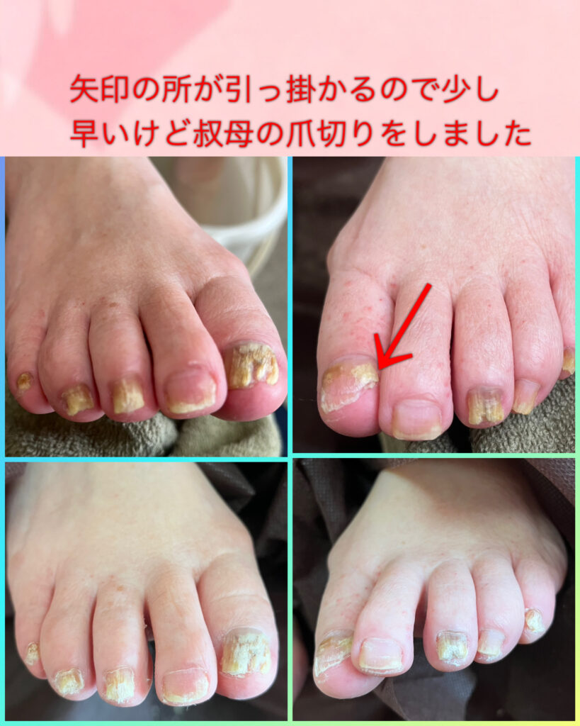 介護予防爪切り🦶✂️🦶